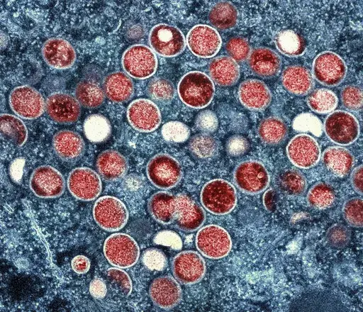 This undated image provided by the National Institute of Allergy and Infectious Diseases shows a colorized transmission electron micrograph of monkeypox particles (red) found within an infected cell (blue), cultured in the laboratory that was captured and color-enhanced at the NIAID Integrated Research Facility in Fort Detrick, Md. (NIAID via AP, File)