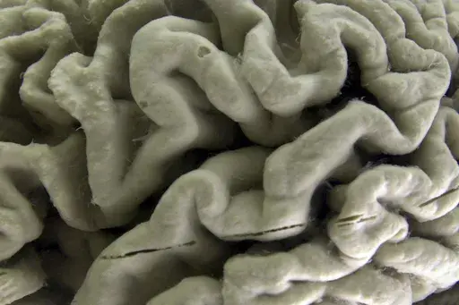 A section of a human brain with Alzheimer's disease is displayed at the Museum of Neuroanatomy at the University at Buffalo, in Buffalo, N.Y., Oct. 7, 2003. A long-feared gene appears to do more than raise people’s risk of Alzheimer’s: Inheriting two copies can cause the mind-robbing disease, according to research published in the journal Nature Medicine on Monday, May 6, 2024. (AP Photo/David Duprey, File)